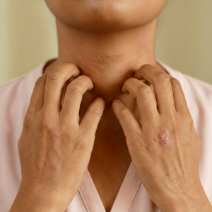 Symptômes de peau atopique et d'eczéma au cou et sur les mains nécessitant une routine de soins naturels avec émollients et sans parfum