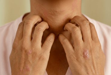 Peau atopique : Définition, symptômes et 5 solutions naturelles pour la soulager