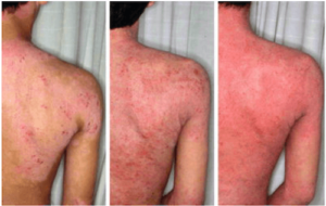 Image illustrant les symptômes du syndrome de la peau rouge (RSS) lié au sevrage à la cortisone (TSW)