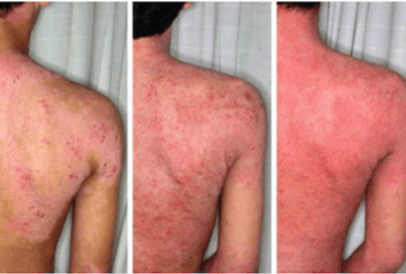 TSW (Topical Steroid Withdrawal) : sevrage de la cortisone et syndrome de la peau rouge