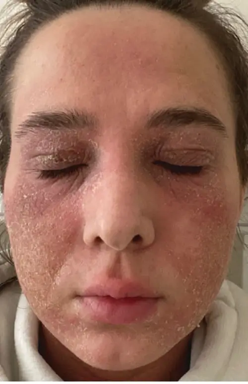 Visage en pleine poussée de TSW : érythème intense, desquamation et œdème, symptômes typiques du Red Skin Syndrome