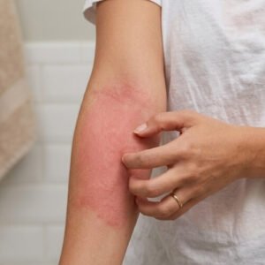 Réaction allergique au gel douche sur le bras : rougeurs et démangeaisons sur peau sensible