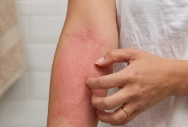 Allergie au gel douche : causes, symptômes et comment y remédier