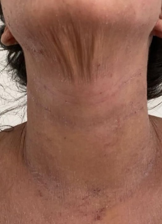 Symptômes du TSW dans le cou : perte d'élasticité, peau sèche, rougeurs et desquamation typiques du syndrome de la peau rouge (RSS)