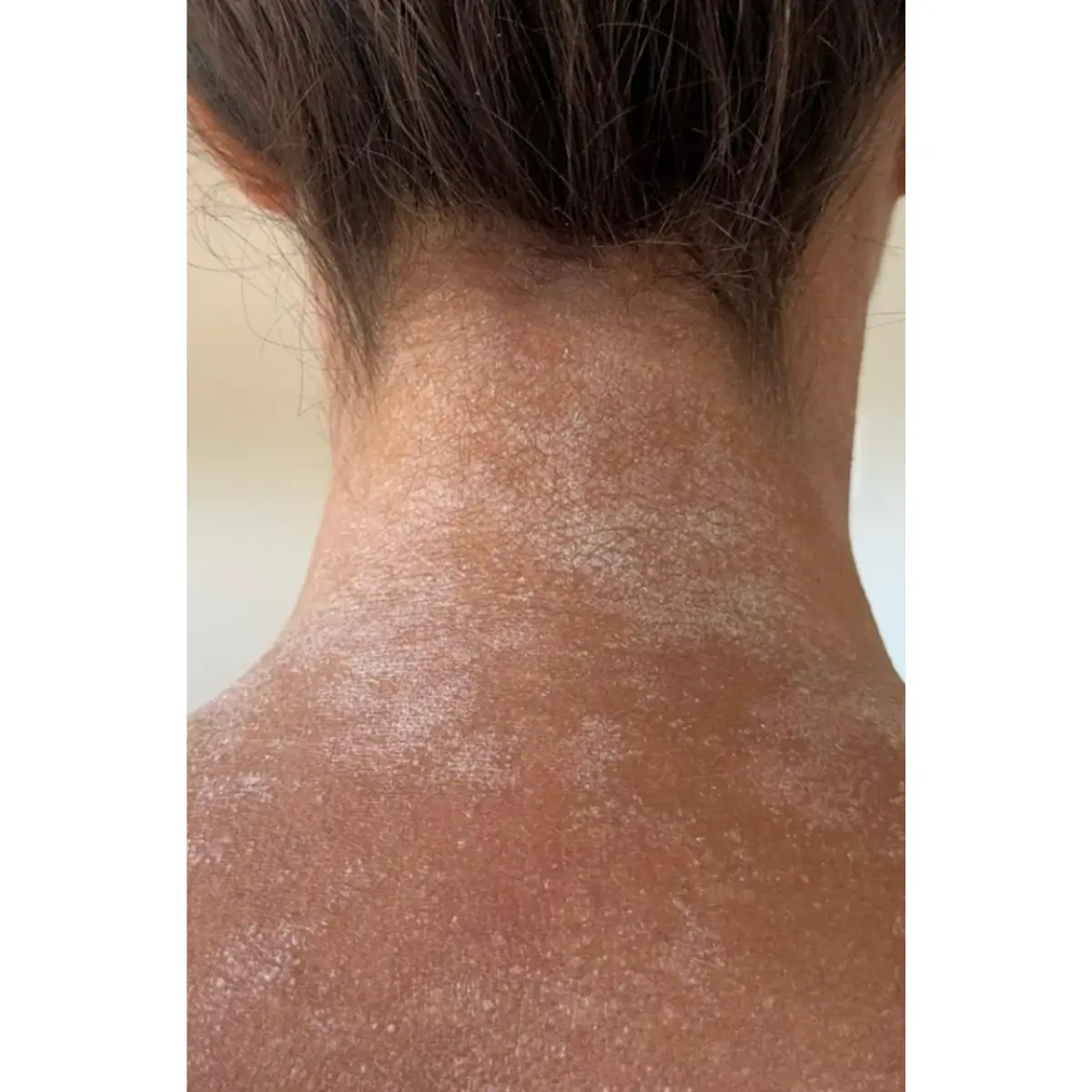 Peau sèche et infection fongique dans le cou, symptomes du TSW