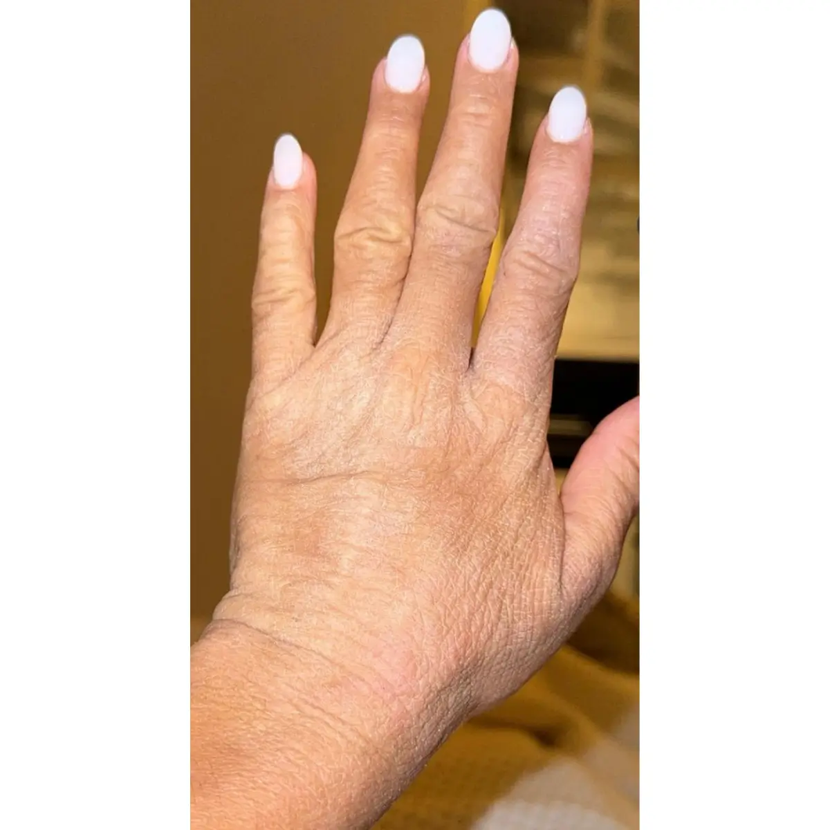 Symptômes du TSW sur les mains : peau d'éléphant, peau sèche, rougeurs et desquamation typiques du syndrome de la peau rouge (RSS)