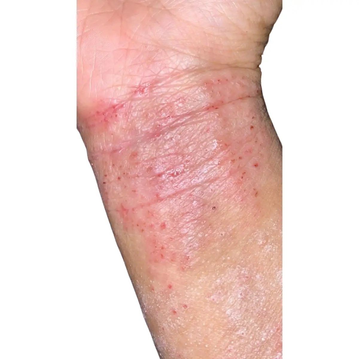 Symptômes du TSW sur le poignet : peau sèche, rougeurs et suintement typiques du syndrome de la peau rouge (RSS)