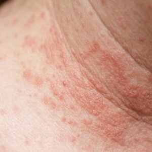 Bouton de chaleur adulte : miliaire rouge sur le cou et le décolleté