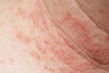 Bouton de chaleur chez l’adulte : causes, symptômes et traitement