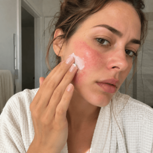 Femme appliquant une crème sur une joue présentant une irritation cutanée