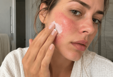 Allergie cutanée : le guide pour reconnaître et stopper la réaction