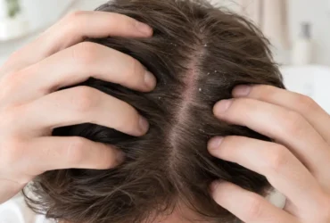 Dermatite séborrhéique du cuir chevelu : plaques, démangeaisons, soins