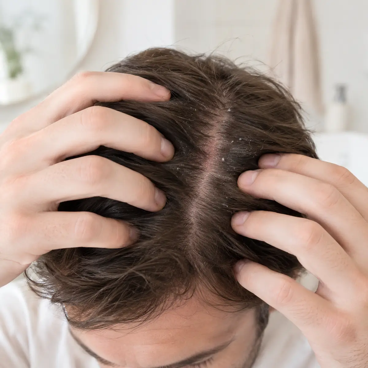 Dermatite séborrhéique du cuir chevelu : plaques, démangeaisons, soins